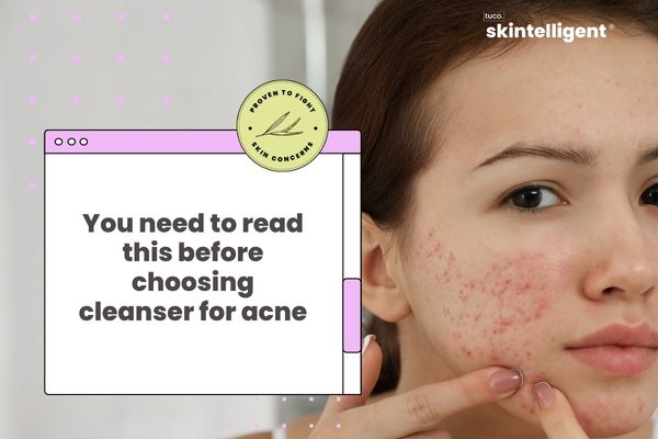 4 Points To Know Before Shortlisting Cleanser for Acne