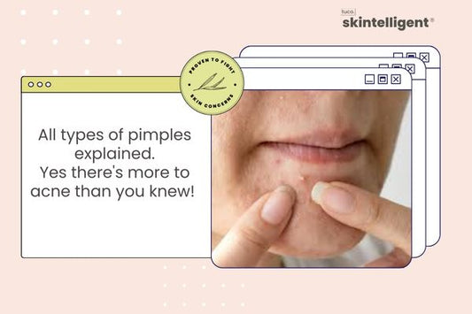 All types of pimples explained